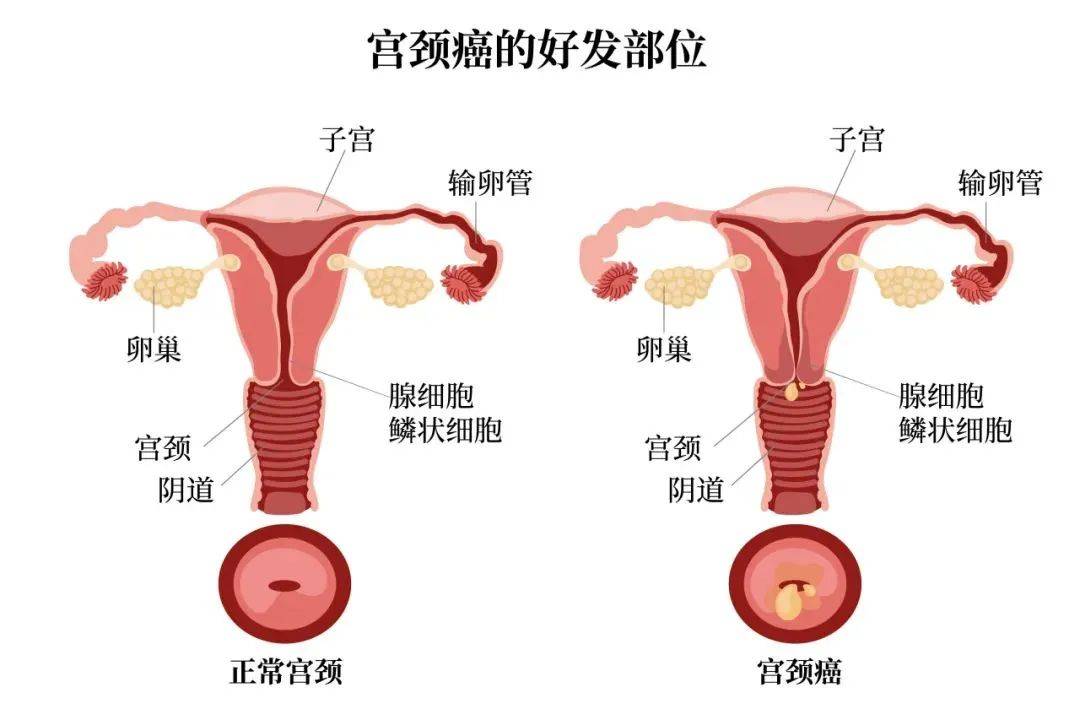 宫颈癌不只是女性的事
