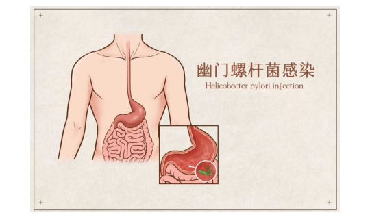 感染幽门螺杆菌后不必恐慌
