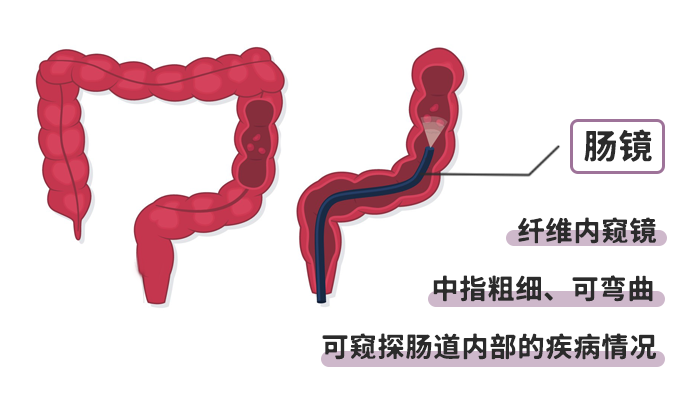 害怕做肠镜?大家担心的7个问题一次讲清!