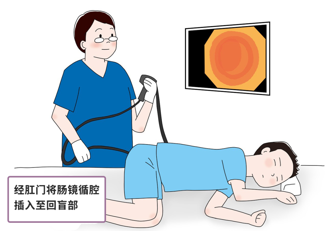 害怕做肠镜?大家担心的7个问题一次讲清!
