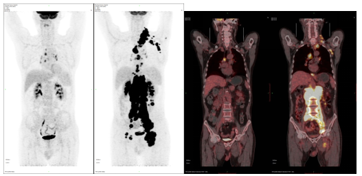 PET-CT分子影像诊断