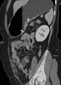胃癌专科化CT检查及结构化报告