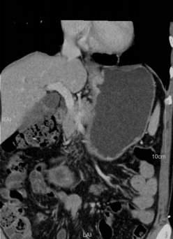 胃癌专科化CT检查及结构化报告