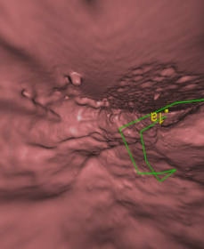 胃癌专科化CT检查及结构化报告