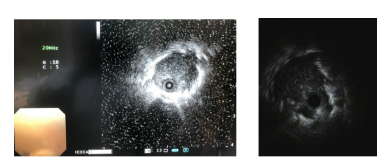 径向超声支气管镜下肺组织者活检术(EBUS-GS-TBLB)