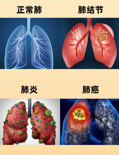 中医护肺，防病于未然——这份呼吸道传染病防控健康提示请收好