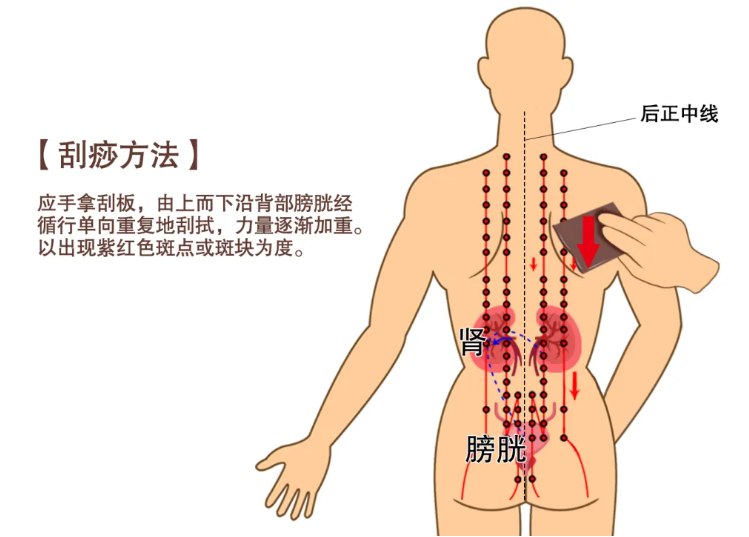 中医经络刮痧：传统疗法的现代解读与临床应用