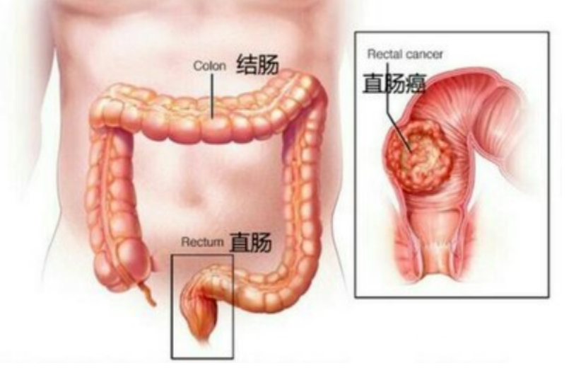 关于直肠癌需要忌口的那些事儿~