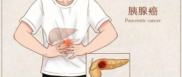 胰腺癌患者增强体质，可以有效的延长生命!