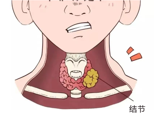 患甲状腺结节后，什么能吃?什么不能吃?