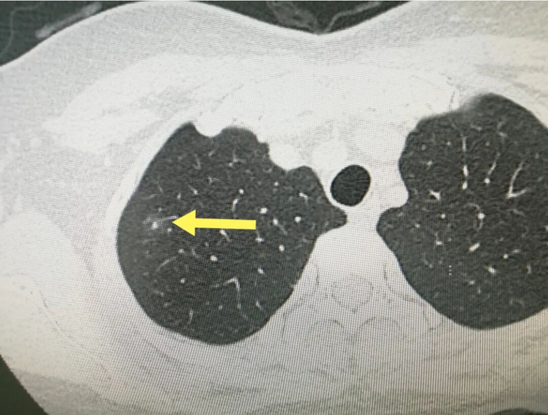中医“组合拳”如何化解 39岁患者“肺部危机”