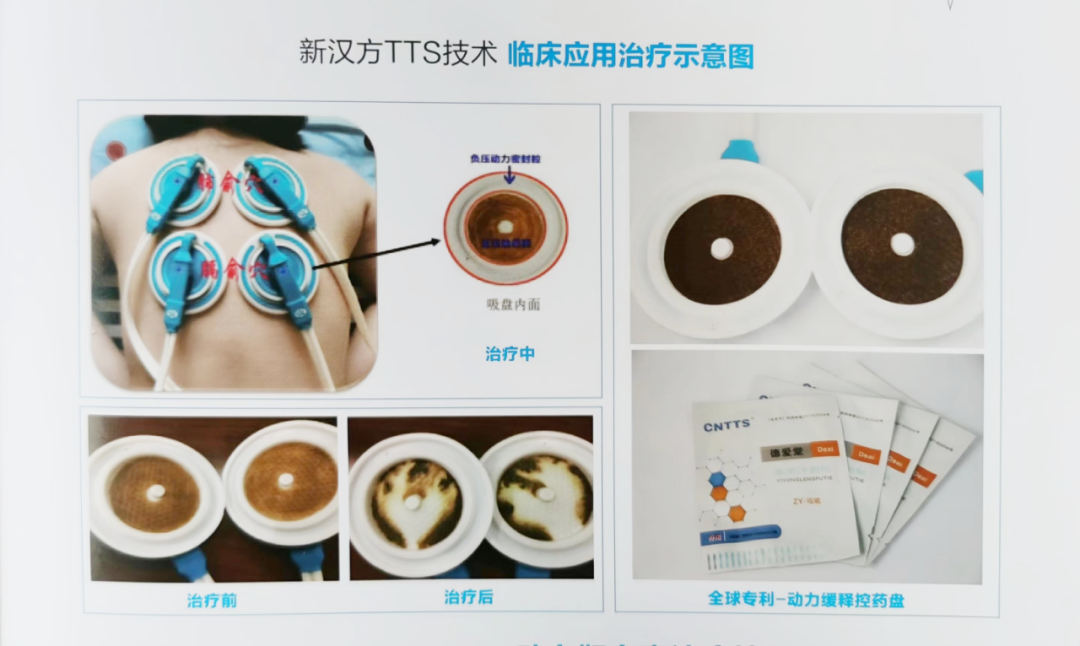 颈部肿块竟是“恶核”?健脾祛痰，实现带瘤生存!